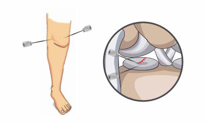 Treatment-of-ligament-injury-causing-knee-pain