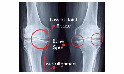 Diagnosis-of-osteoarthritis