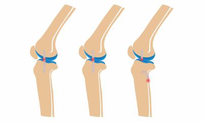 Grades-of-ligament-injury-causing-knee-pain