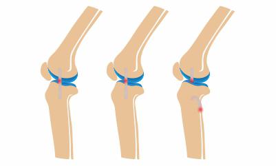 Grades-of-ligament-injury-causing-knee-pain