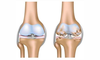 Osteoarthritis