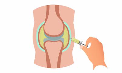 Septic-arthritis-aspiration