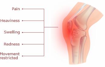 Symptoms-Knee-Effusion