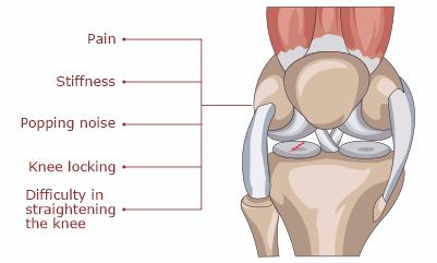 Symptoms-of-Meniscal-Tear