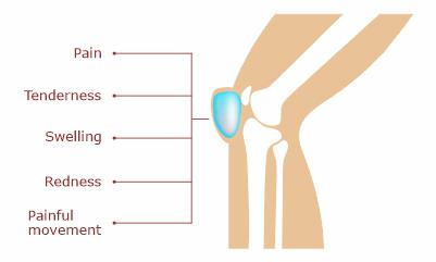 Symptoms-of-knee-bursitis