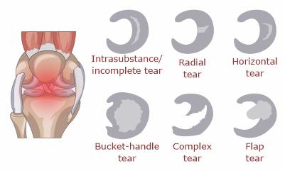 Types-of-meniscal-tear-causing-knee-pain