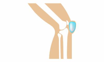 knee-pain-due-to-bursitis