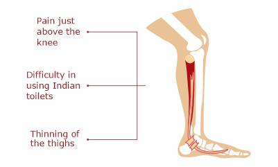 symptoms-og-knee-pain-due-to-muscle-weakness